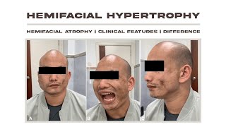 Hemifacial Hypertrophy Vs Hemifacial Atrophy  clinical Features  Etiology [upl. by Regina]