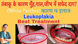 Leukoplakia in Hindi  मुँह के अंदर सफ़ेद दाग कैसे ठीक करे   Leukoplakia [upl. by Karney]