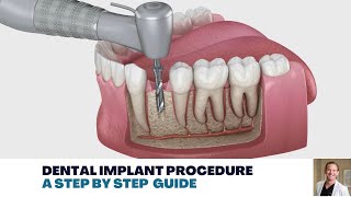 Dental Implant Procedure A Step by Step Guide [upl. by Hnim]