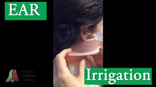 Ear Irrigation for Cerumen Ear Wax Removal  Auburn Medical Group [upl. by Anyrak782]