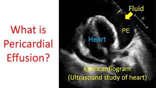 What is pericardial effusion [upl. by Enneles704]