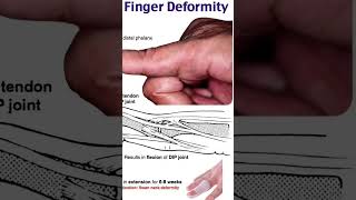 mallet finger deformitythephysiodoctoranatomyphysiotharapisthumananatomymotivationbiology [upl. by Ahsirahc686]