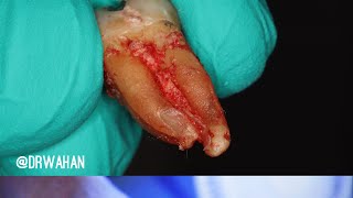 Molar Extraction with Help From Cowhorn Forceps [upl. by Hubie997]