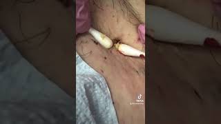 Large blackhead w 3 openings [upl. by Flo]