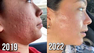 Microneedling Session 8 Before  After [upl. by Charla]