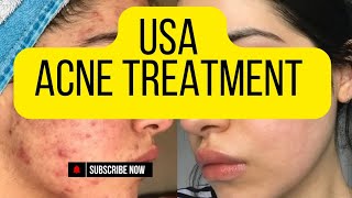 Top Acne Treatment Tips for Clear SkinUnited States Acne Treatment [upl. by Helsell]