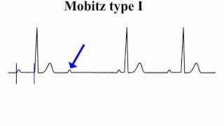 ECG Interpretation  AtrioVentricular Block [upl. by Elletnuahs]