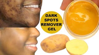 YOUR DARK SPOTS WILL BE GONE OVERNIGHT APPLY AT NIGHT TO DARK SPOTS WAKE UP WITH CLEAR SKIN [upl. by Nuri]