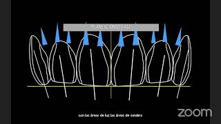 ESTRATIFICACION EN RESINA COMPUESTA [upl. by Grieve]