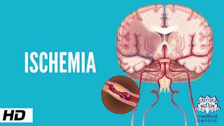 Ischemia Causes Signs and Symptoms Diagnosis and Treatment [upl. by Ecirp304]