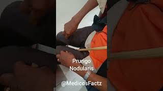 Prurigo Nodularis [upl. by Moreno]