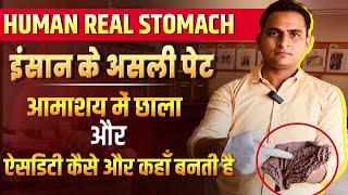 FullVideoAcidity amp Gastric Ulcer in Real Stomach  इंसान के असली पेट में ऐसिडिटी और छाले viral [upl. by Hsekar]