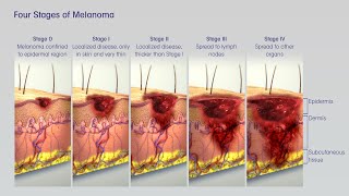 Treatment of Melanoma Skin Cancer by Stage [upl. by Nnov133]