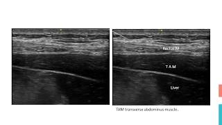 TAP Block Subcostal [upl. by Goldin]