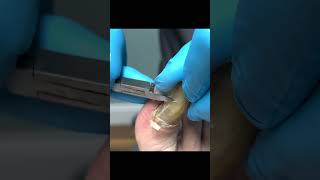 Super long nails foot nails toenails footdoctor podiatry [upl. by Eltsyrk736]