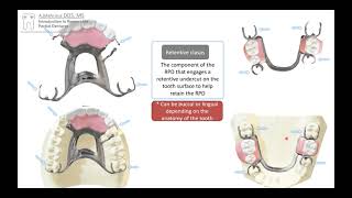 Introduction to RPD In 10 Mins RPD  Removable Partial Denture online Course [upl. by Nhguavahs502]