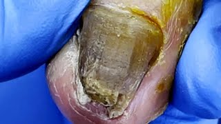 Pedicure Tutorial：Huge toenail trimming，severe onychomycosis【Pedicure Master Lin Jun】 [upl. by Atinit748]