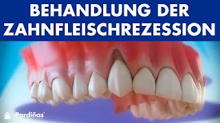 Zahnfleischrückgang – Behandlung der Zahnfleischrezession © [upl. by Ahsilat]