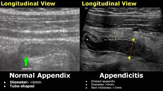 Appendix Ultrasound Normal Vs Abnormal Image Appearances  Appendicitis USG Scan [upl. by Henricks]