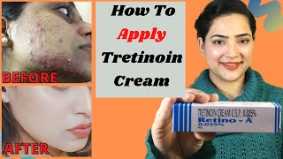 Retino A 0025cream Review  Before amp After Tretinoin Cream Review  My experience with tretinoin [upl. by Ahsilram461]