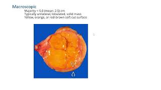 Leydig cell tumorGYNpath [upl. by Ilajna]