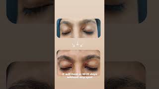 Xanthelasma palpebrarum Removal  Dr Sanchika Gupta 👩‍⚕️ [upl. by Ebag847]