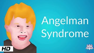 Angelman Syndrome Causes Signs and Symptoms Diagnosis and Treatment [upl. by Oirramaj]