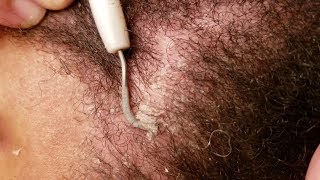 Dandruff Scratching Flaky Edges Removal With Dental Pick [upl. by Bills605]