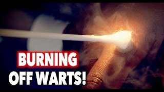 BURNING OFF WARTS with liquid nitrogen  Dr Paul [upl. by Adriene623]