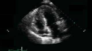 Pericardial Effusion Pulmonary Edema [upl. by Egnalos]