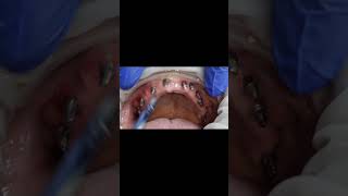 Failed vs succesfull basal dental implants tapping test for upper maxillary arch [upl. by Quartet]