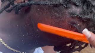 Dry scalp big flakes removal [upl. by Kai]