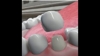 Dental Crowns What They Are amp Why We Need Them [upl. by Afra]