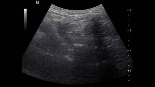 Ultrasound guided fluoroscopic verified lumbar transforaminal epidural injection [upl. by Ahseym348]