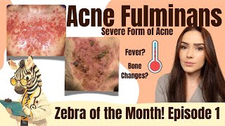 Acne Fulminans  A Severe Acne Variant  Zebra of the Month [upl. by Hahseram592]