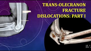 TRANSOLECRANON FRACTURE DISLOCATIONS PART I NONGRAPHIC [upl. by Aryc]