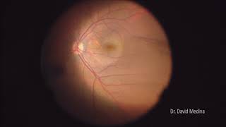 Epiretinal membrane and Lamellar Macular Hole [upl. by Targett]