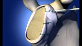 Shoulder Labral Repair  old [upl. by Luapnaes]