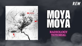 Moya Moya Disease Radiology Tutorial  radiology [upl. by Attenna]