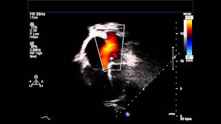 Secundum ASD Apical Four Chamber Color Doppler [upl. by Traci]