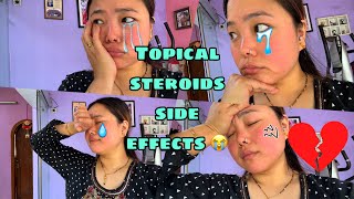 TOPICAL STEROIDS withdrawal Side Effect 😱 Skin update after leaving steroid cream Vlog [upl. by Filler]