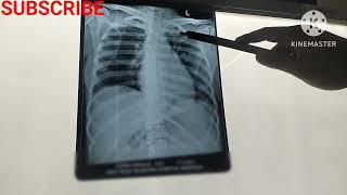 Basic Chest X Ray Interpretation for Nursing OfficerChest XRay कैसे देखे [upl. by Onin]