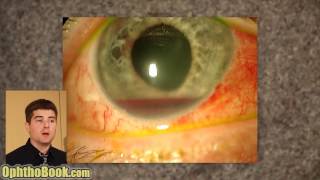 Exploding Eye Lecture [upl. by Amadus]