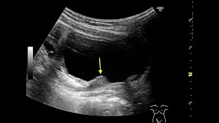 POST TRANSURETHRAL INJECTION USING DEFLUX [upl. by Ellenehs]