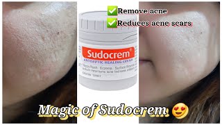 Sudocrem for acne  How to use sudocrem amp its benefits  One skincare solution [upl. by Ainoda150]