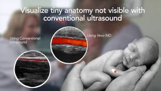 Vevo MD  The Worlds First UltraHigh Frequency Ultrasound System [upl. by Fernande]