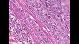 Histopathology Urinary bladderTransitional cell carcinoma [upl. by Woll]