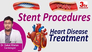 Stent Procedure for Heart Blocks I Heart Disease Treatment I Dr Saket [upl. by Marcellus194]