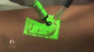 Augmented Reality VeinViewer technology on varicose veins treatment Novo Tratamento Varizes [upl. by Erdrich]