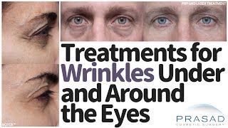 How to Treat Wrinkles Under and Around the Eyes [upl. by Ettelra]